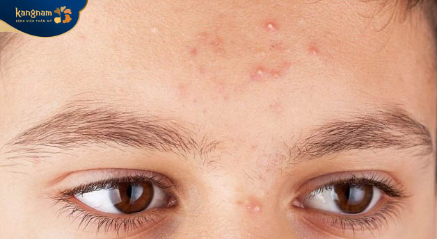 Mụn đầu trắng được gọi là nhân đóng