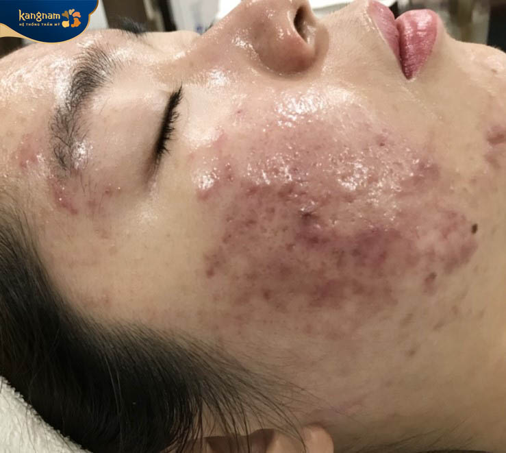 Tình trạng mụn viêm đỏ trên mặt B.M.T trước khi điều trị mụn