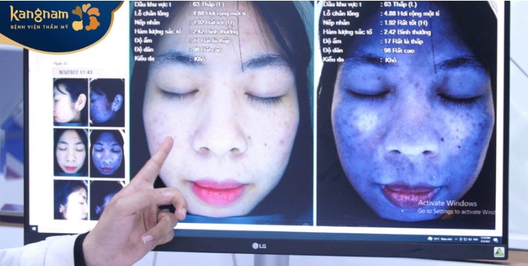 Soi da đánh giá chuyên sâu về tình trạng da của T trước khi đưa ra giải pháp trị liệu