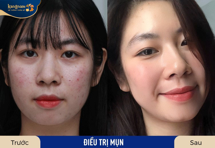 Làn da của B.M.T đã trở nên mịn màng, căng bóng sau điều trị mụn