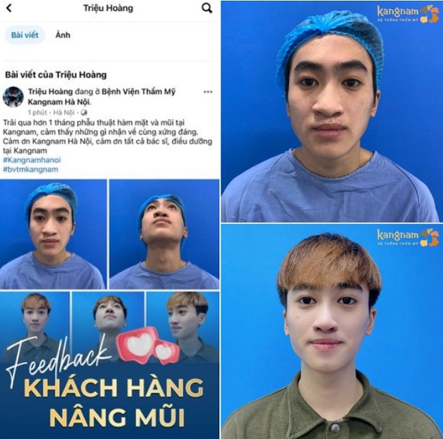 Khách hàng Triệu Hoàng đã được sở hữu dáng mũi mới và cảm thấy rất hài lòng