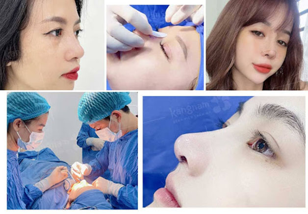 Phẫu thuật nâng mũi bằng sụn tai