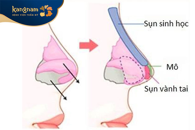 Sụn tự thân có độ tương thích cao với cơ thể