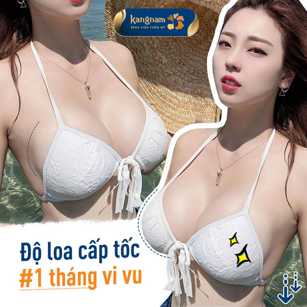 Nâng ngực đặt túi độn nội soi