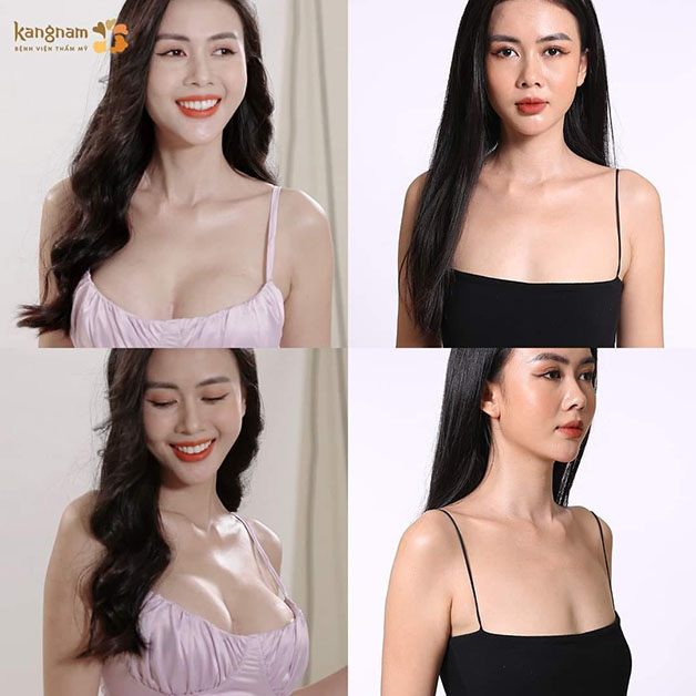 Khách hàng rạng rỡ và hạnh phúc với dáng ngực mới