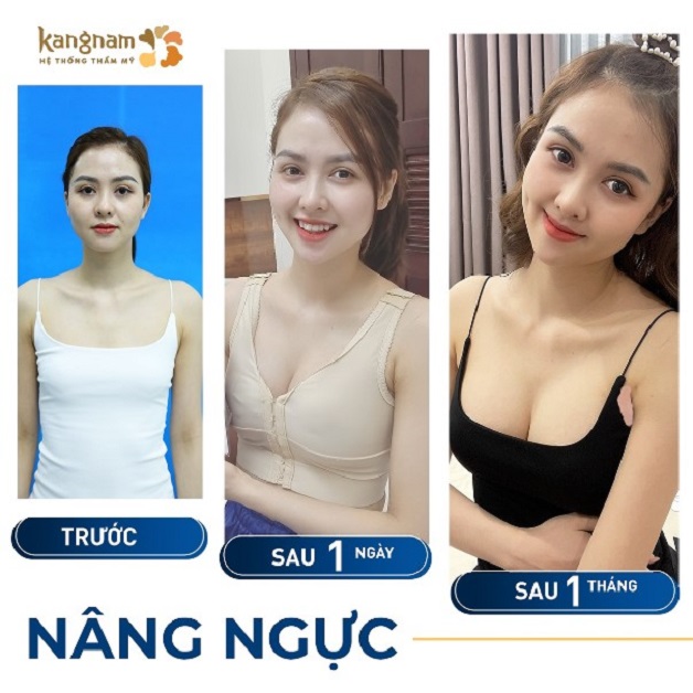 Chị Huyền Giang chia sẻ hình ảnh sau khi nâng ngực