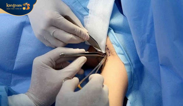 Phẫu thuật nâng ngực bằng đường nách