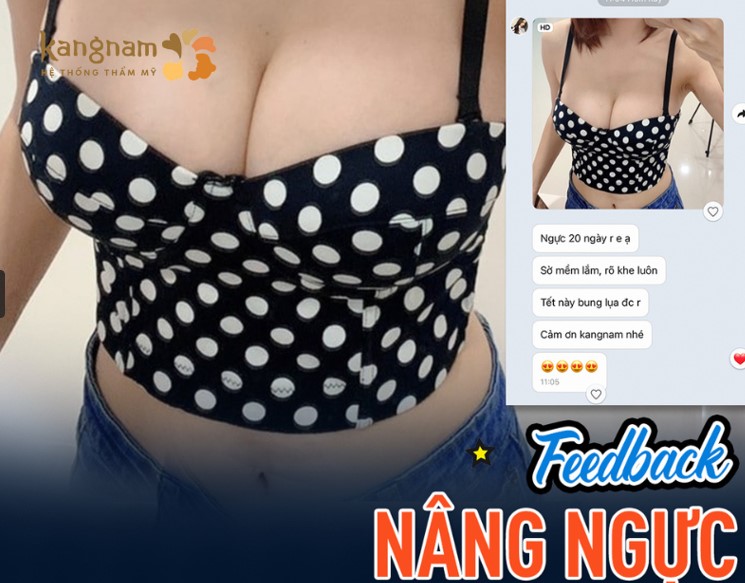 “Ngực sau 20 ngày nâng, sờ mềm mại, rõ khe lắm luôn. tết này bung lụa được rồi. Cảm ơn Kangnam nhé”.