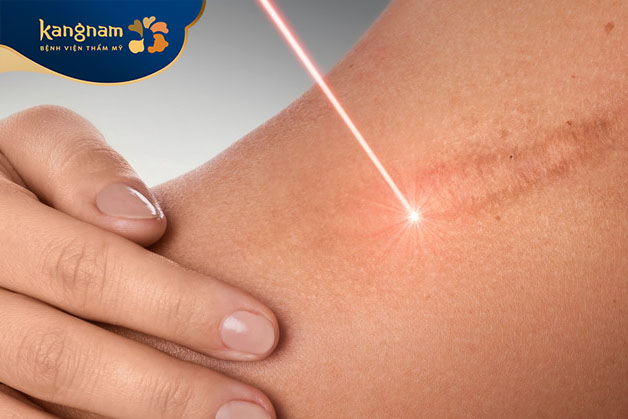 Laser Fractional CO2 tạo ra tác động quang nhiệt vi phân