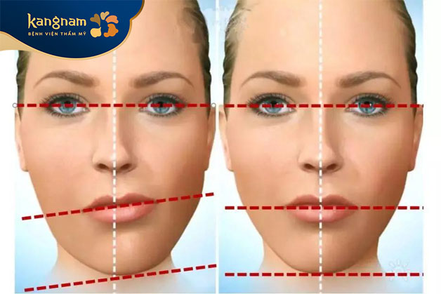 Triệu chứng mặt lệch