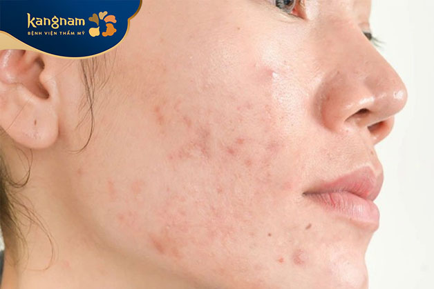 Sự biến động hormone cũng gây mụn ẩn