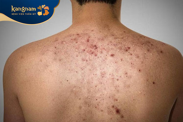 Tắt nghẽn lỗ chân lông gây mụn bọc ở lưng