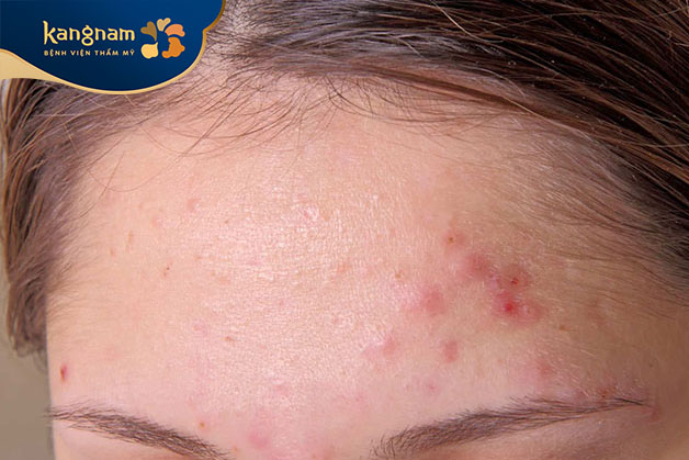 Thay đổi hormone trong cơ thể dẫn đến mụn trên trán