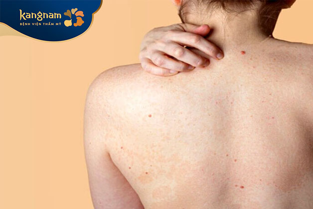 Mụn đầu đen ở lưng xuất hiện do sự gia tăng sản xuất dầu trên da