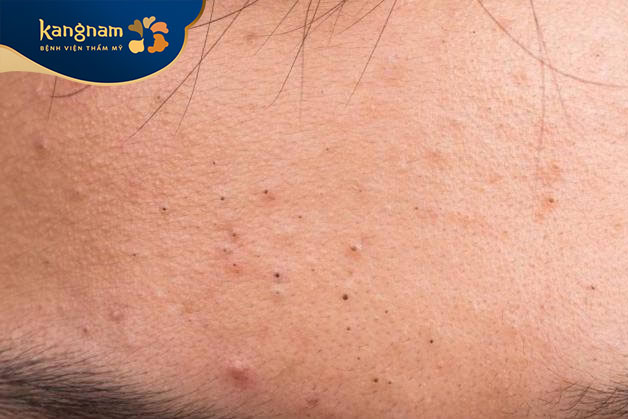 Mụn đầu đen ở trán