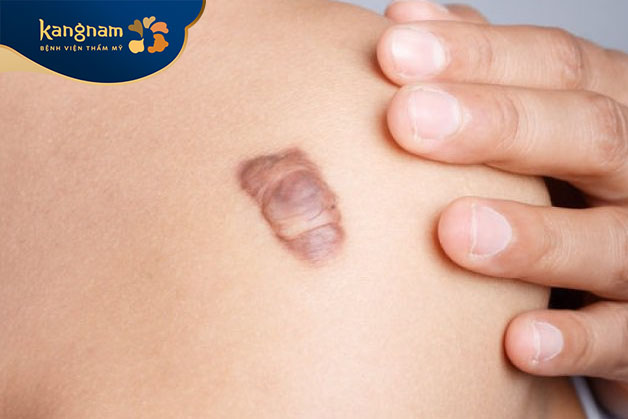 Khi bị mụn trứng cá hoặc thủy đậu, chúng có thể để lại vết thương trên da, góp phần hình thành sẹo lồi.