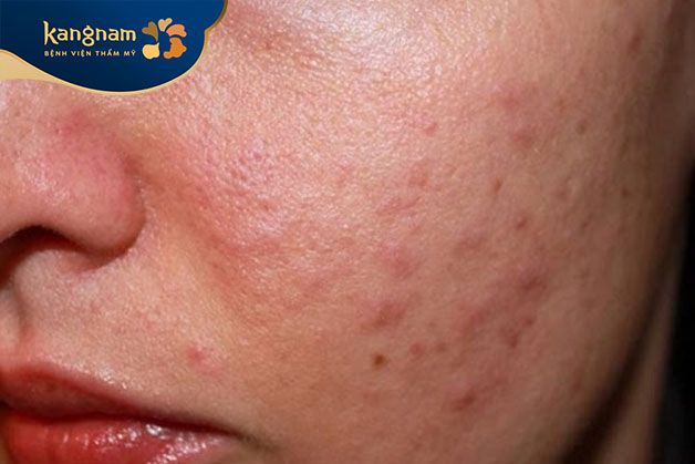 Mụn ẩn ở má