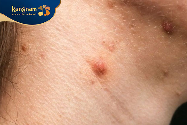 mụn bọc thường xuất hiện dưới dạng mụn viêm sưng đỏ, đau nhức do chân mụn nằm sâu trong ra