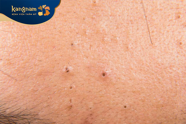 Mụn đầu đen không gây sưng đỏ hoặc đau nhức