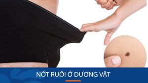 Nốt ruồi ở Dương Vật: Nên lo lắng hay không và cách xử lý hiệu quả?