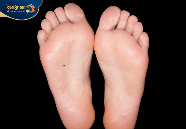 theo nhân tướng học, đa số người sở hữu nốt ruồi lòng bàn chân đều là những người có phúc tướng