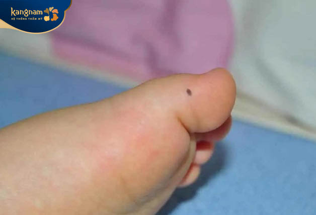 Nốt ruồi ở ngón chân cái
