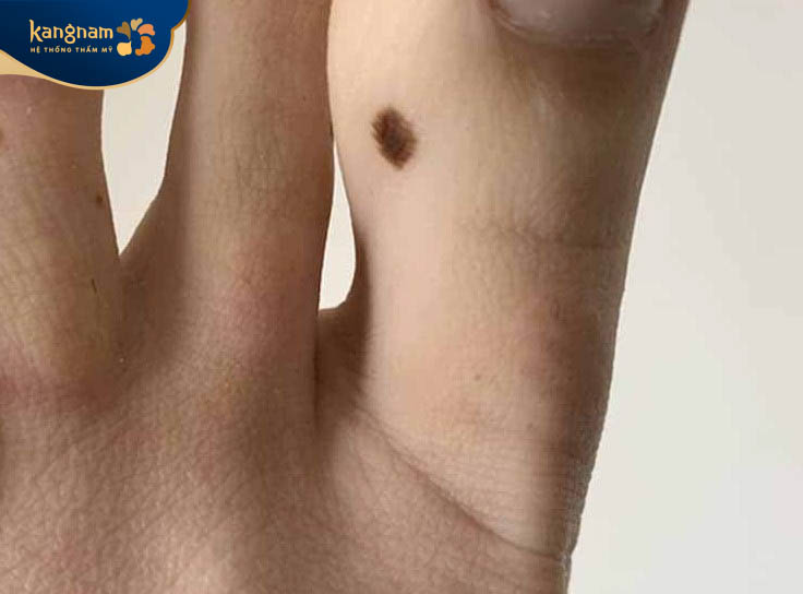 Người ở hữu nốt ruồi ngón chân cái là người cầu tiến, có tài ăn nói và thuyết phục người khác