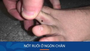 Hé lộ ý nghĩa nốt ruồi ở từng ngón chân: Tốt hay xấu?