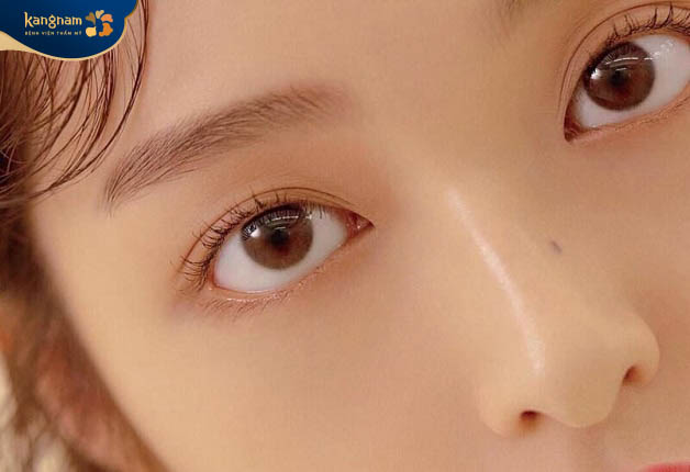 Nốt ruồi mọc ở sống mũi với nhiều màu sắc