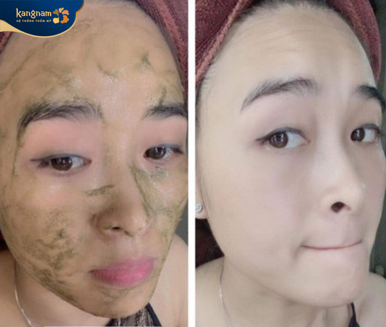 Quá trình peel da tảo biển giúp làm sạch sâu bên trong lỗ chân lông