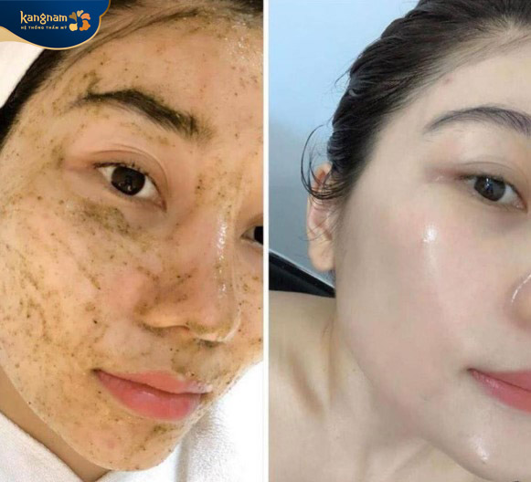 Làn da có sự thay đổi rõ rệt sau peel