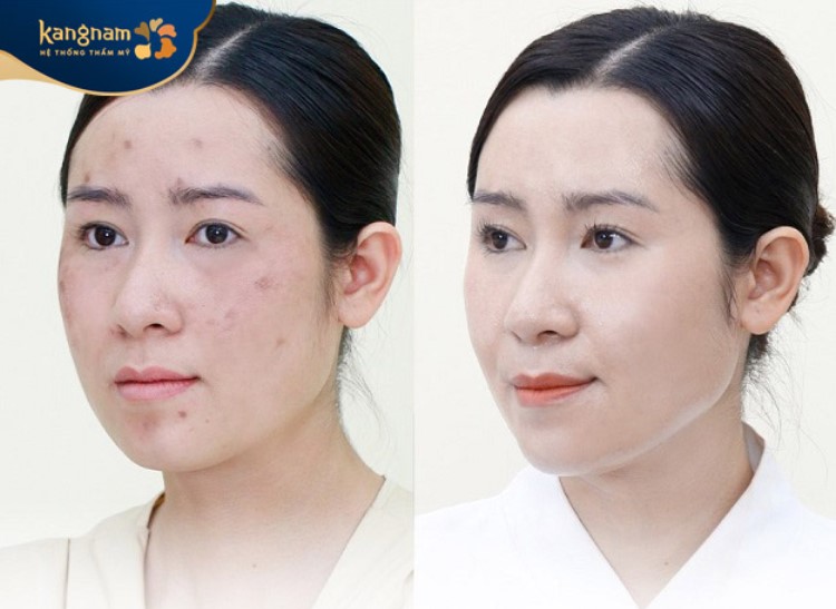 Giảm mụn, thâm đáng kể sau khi peel