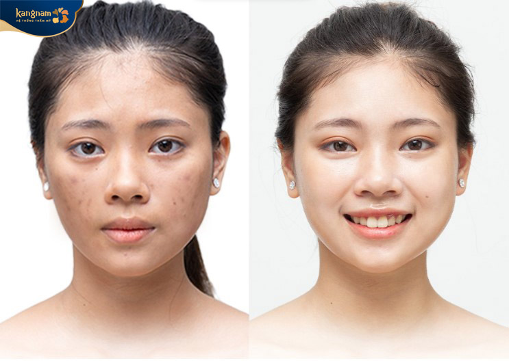 Làn da không bị kích ứng, nổi mẩn đỏ,...sau peel