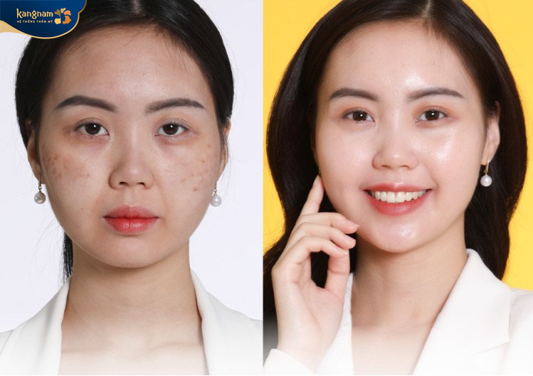 Khách hàng hài lòng với sự thay đổi rõ rệt sau peel