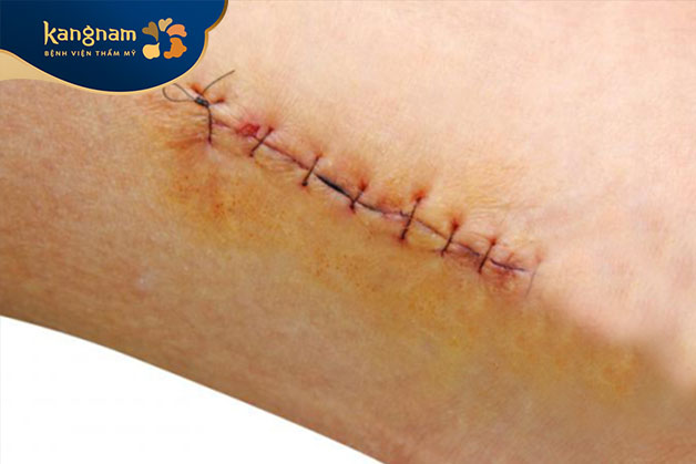 Phẫu thuật trị sẹo lồi là phương pháp được áp dụng khi các phương pháp khác không mang lại kết quả