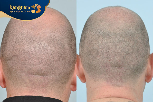 Phù hợp với bất cứ ai, không đào thải, không tái phát