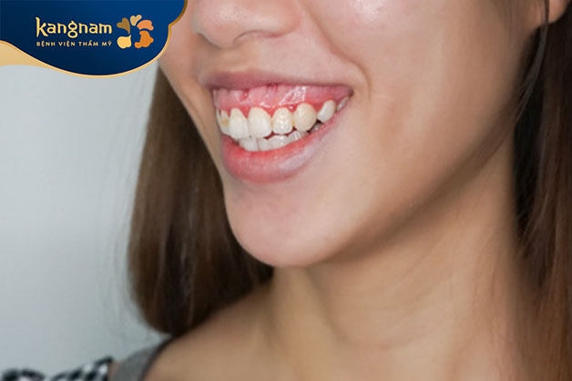 Tính cách thảo mai, không trung thực, thường có tính xấu