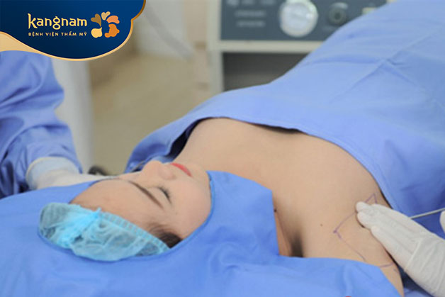 Công nghệ hút tuyến mồ hôi nách Endo Dry là phương pháp tiên tiến