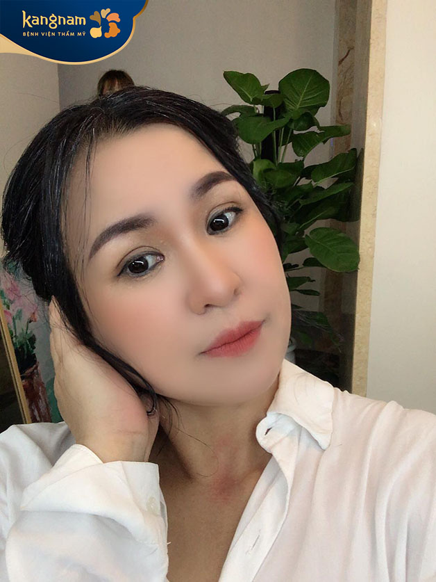 Da chị Thủycăng mịn và trẻ trung sau khi căng chỉ X line