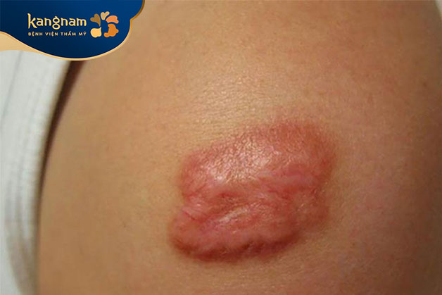 Sẹo lồi cơ địa