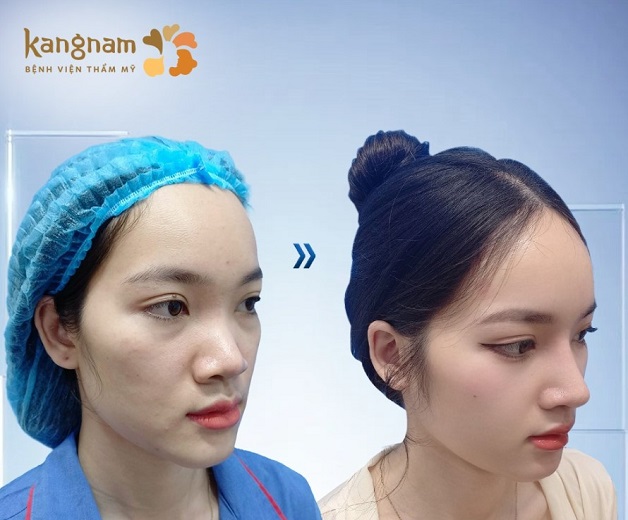 Phẫu thuật thẩm mỹ khắc phục mọi khuyết điểm trên mũi