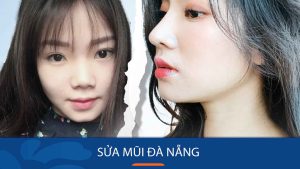 sửa mũi kangnam đà nẵng đẹp đáng tin cậy