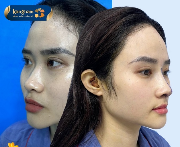 Nhu cầu sửa mũi của khách hàng tại Hải Phòng ngày càng tăng