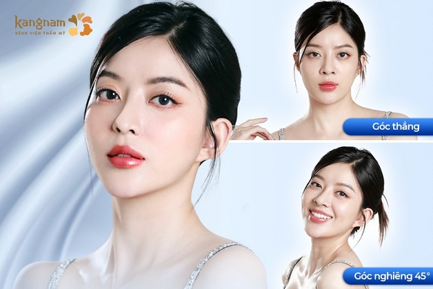 Phẫu thuật thẩm mỹ là phương pháp cải thiện dáng mũi toàn diện