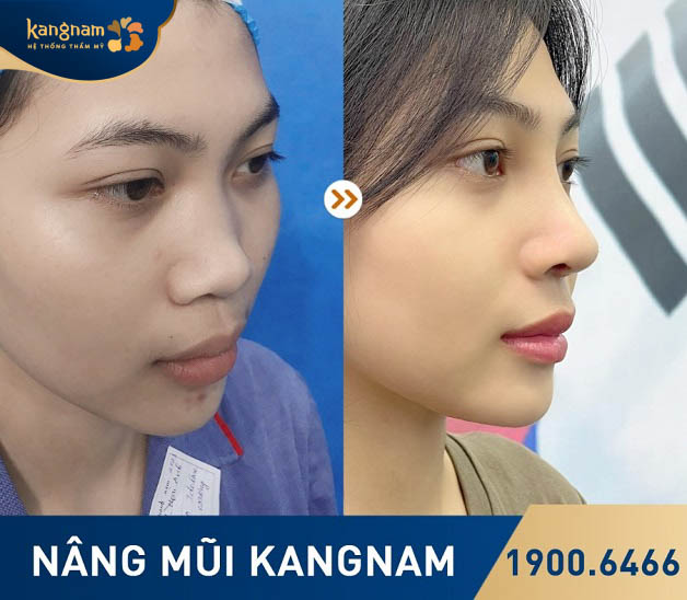 Khuyết điểm sống mũi thấp, đầu mũi tẹt, cánh mũi to được khắc phục