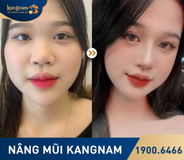 Khách hàng cảm thấy tự tin và hạnh phúc hơn sau nâng mũi tại Kangnam