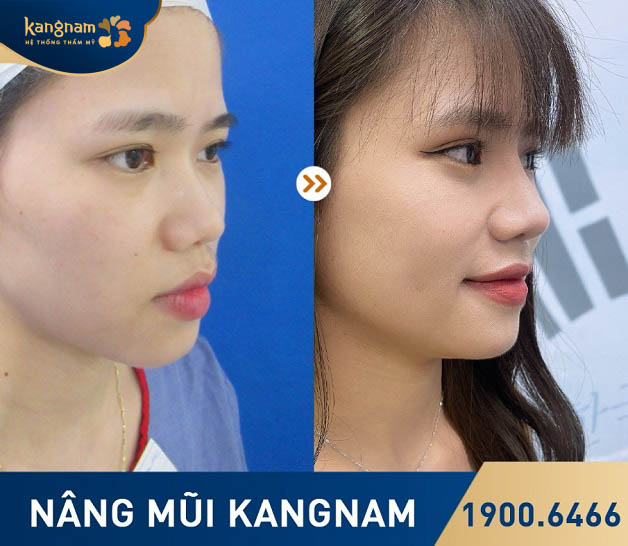 Khách hàng hài lòng với chất lượng dịch vụ nâng mũi tại Kangnam Hải Phòng