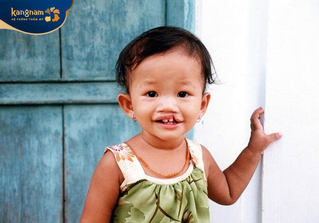 Có nhiều nguyên nhân dẫn đến tình trạng dị tật sứt môi, hở hàm ếch