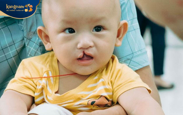 Tình trạng sứt môi và hở hàm ếch ảnh hưởng rất nhiều đến sự phát triển của trẻ nhỏ