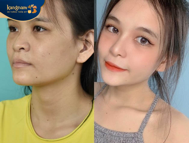 Phẫu thuật chỉnh hình khắc phục tình trạng sứt môi, hàm ếch